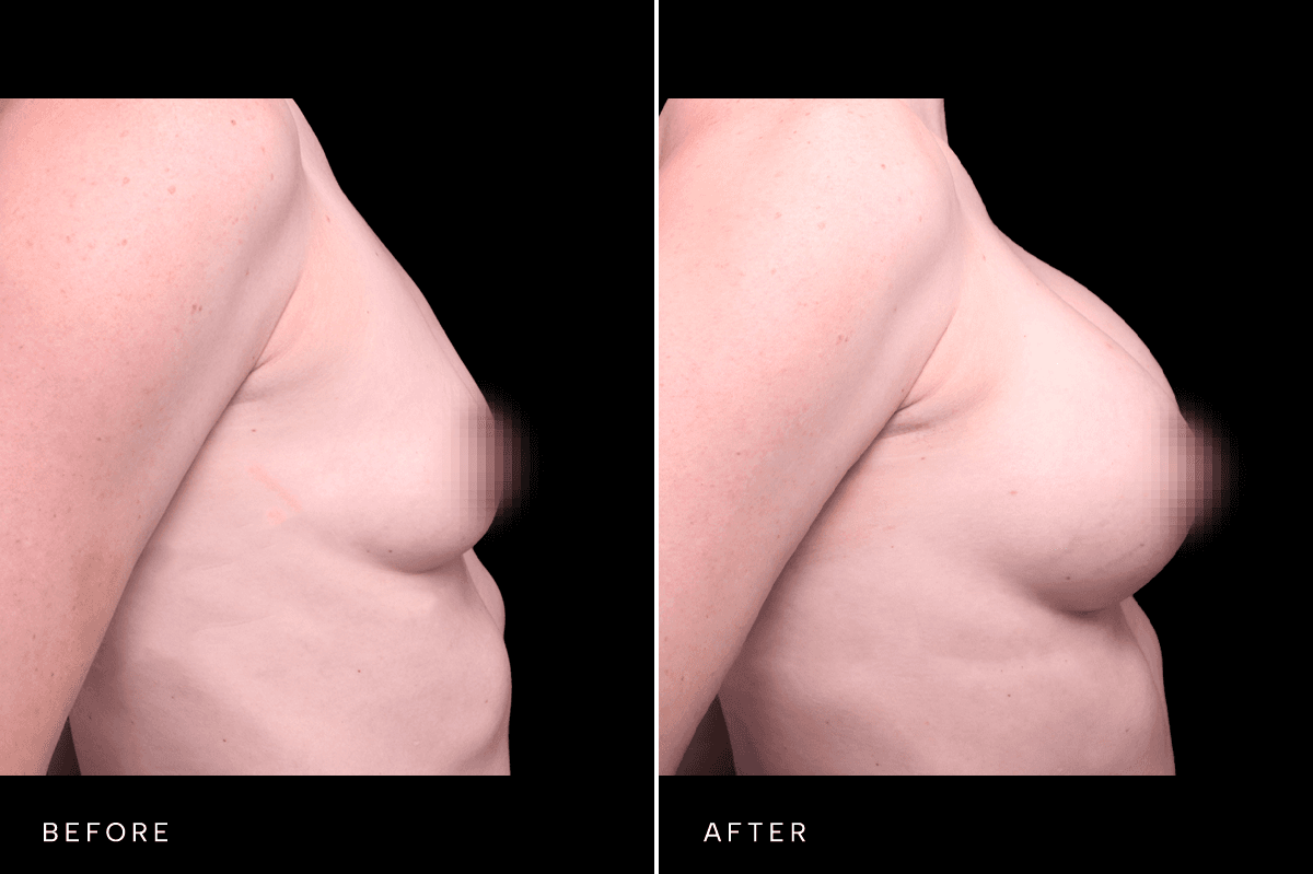Omni Breast Gallery - BAM 6305 - B Side