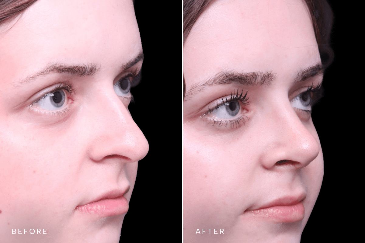 Omni Rhinoplasty Before and After — RHINO 5553 - C Angle